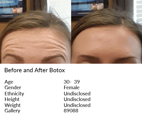 A woman 's face before and after botox.