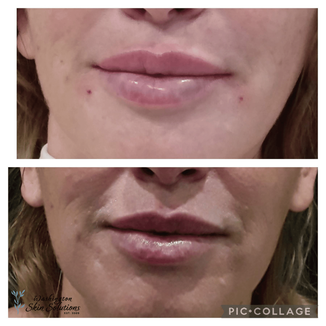 A woman 's lips before and after using the lip lift.