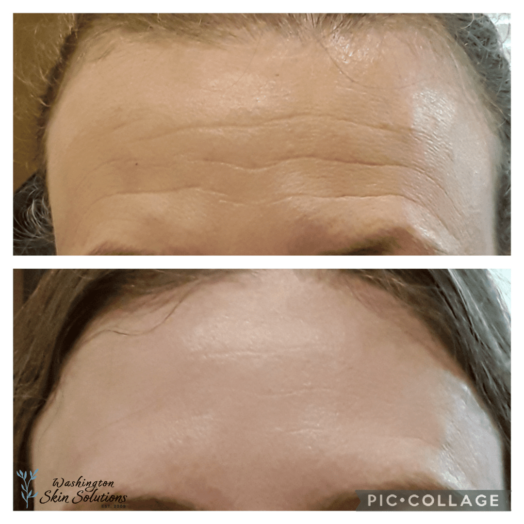 A woman 's forehead before and after botox.