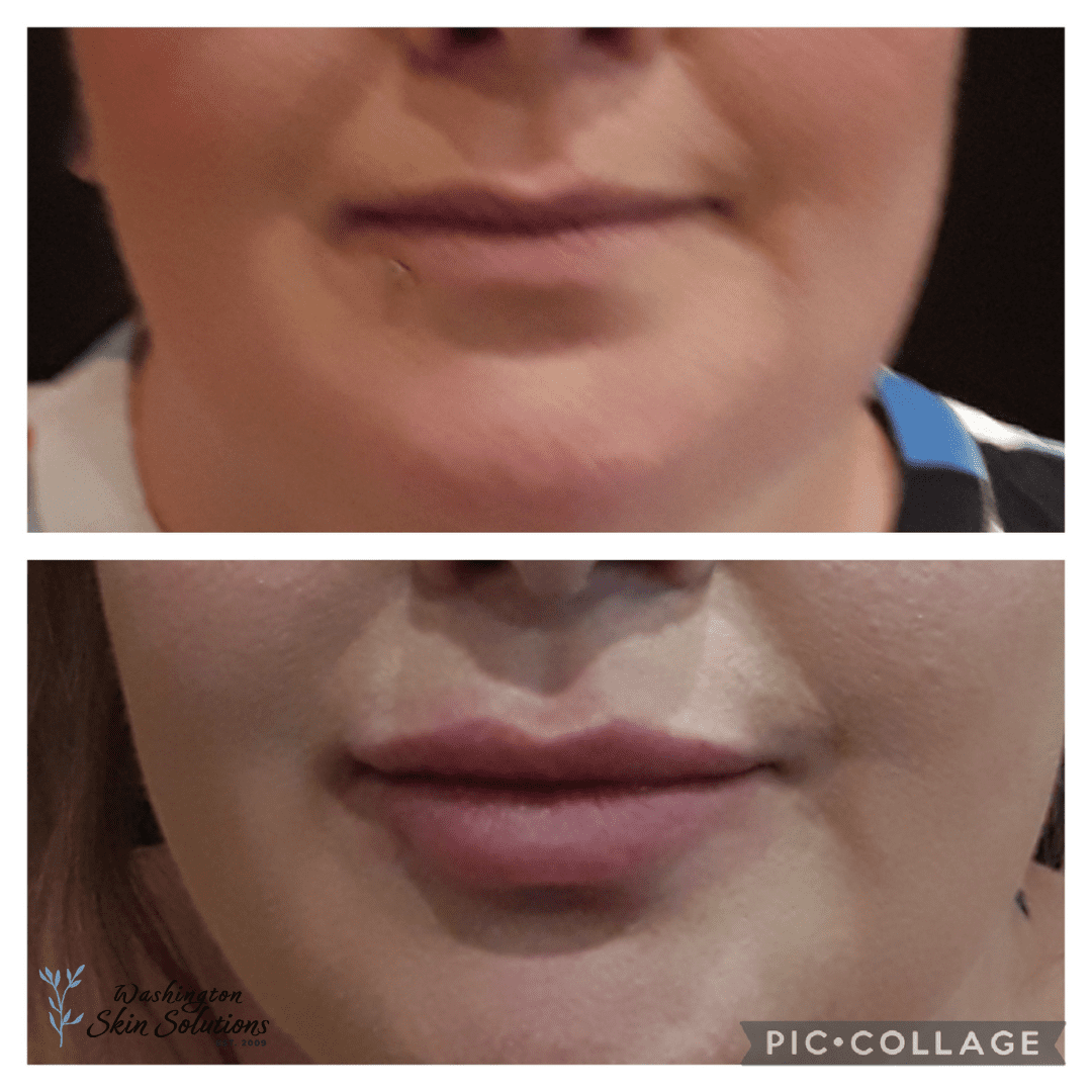 A woman with a lip augmentation before and after.