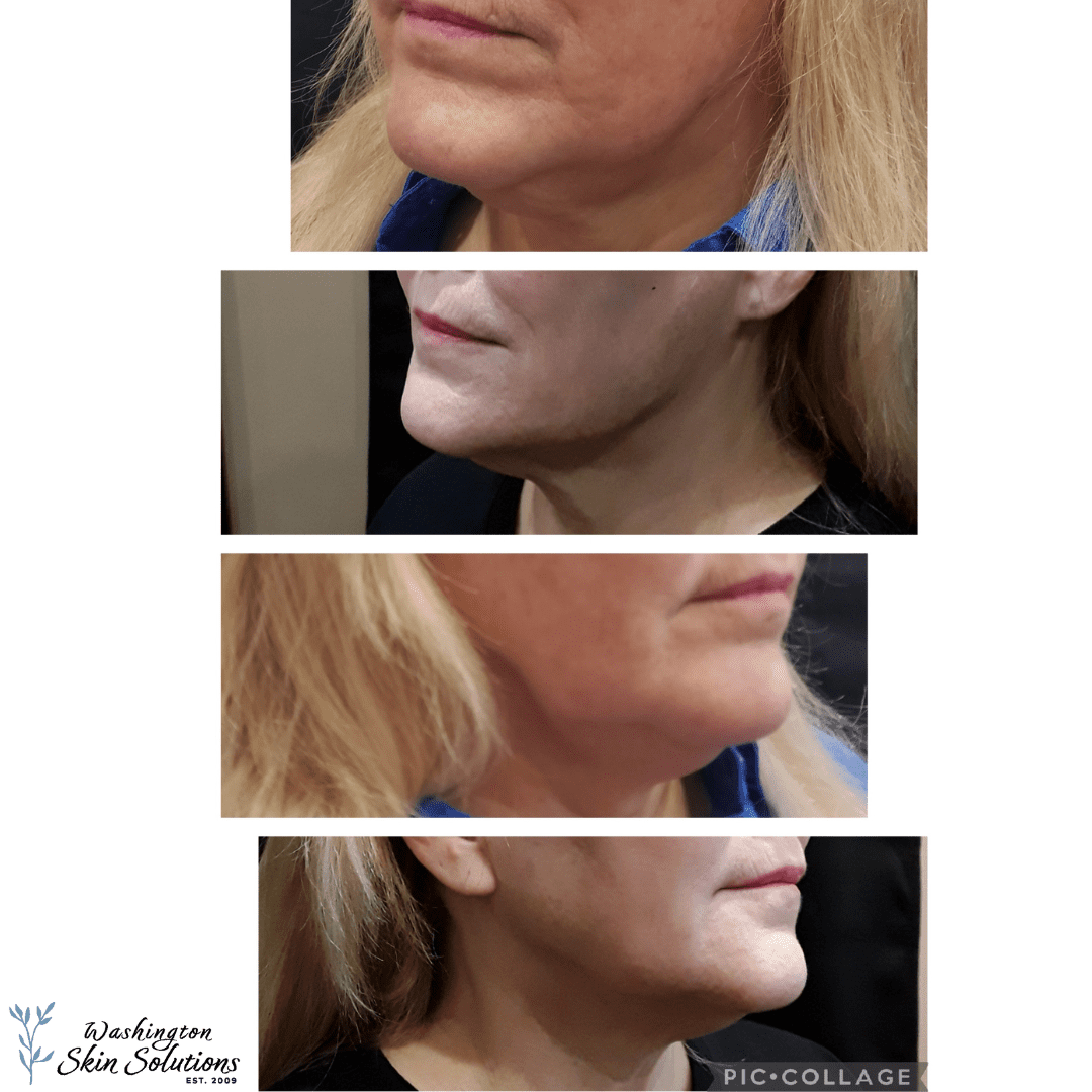 A woman 's face before and after undergoing an injectable procedure.