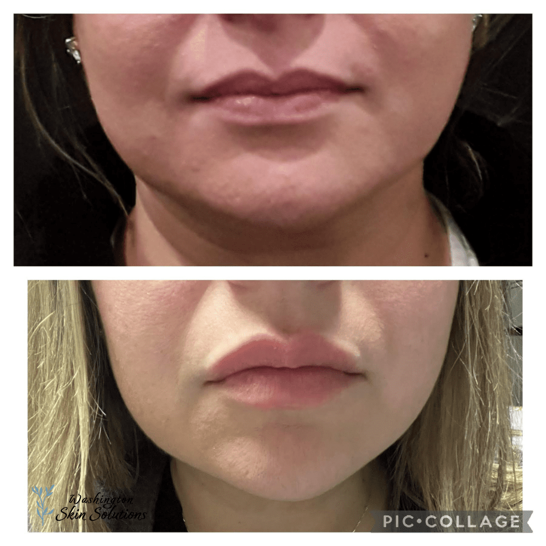 A woman 's before and after photo of her lips.