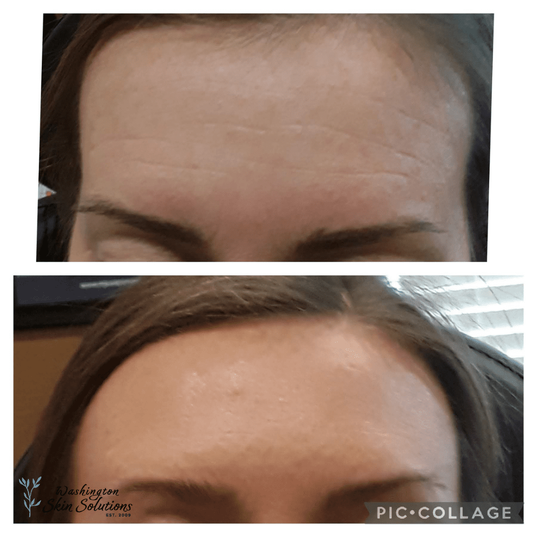 A woman 's forehead before and after botox.