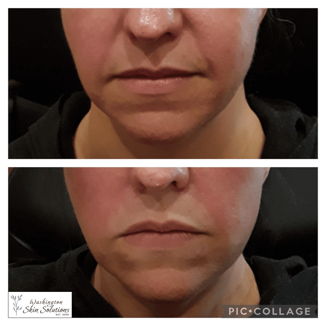 A woman 's face before and after using the procedure.